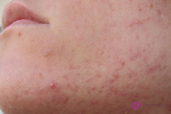 hormonal acne solutions to treat acne