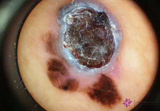 nodular melanoma dermoscopy incidence of skin cancer has increased