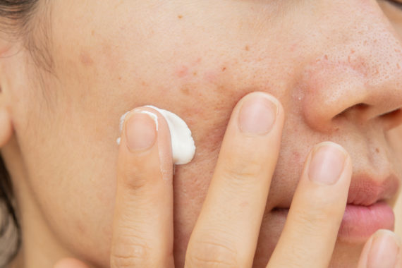 topical acne treatment
