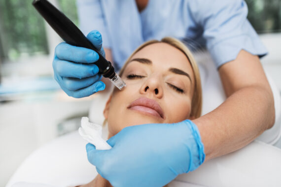 microneedling treatment for acne scars